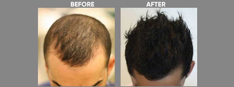 Hair Disorder Treatment