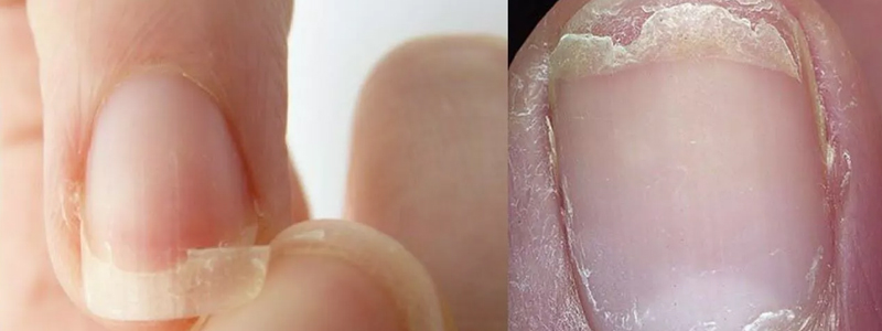 Nail Disorder Treatment