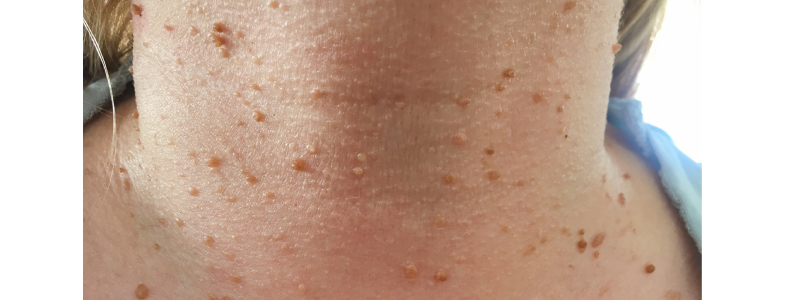 Unwanted Growth on the Skin